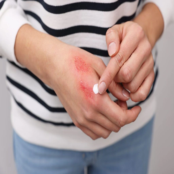 Burn and scald injuries